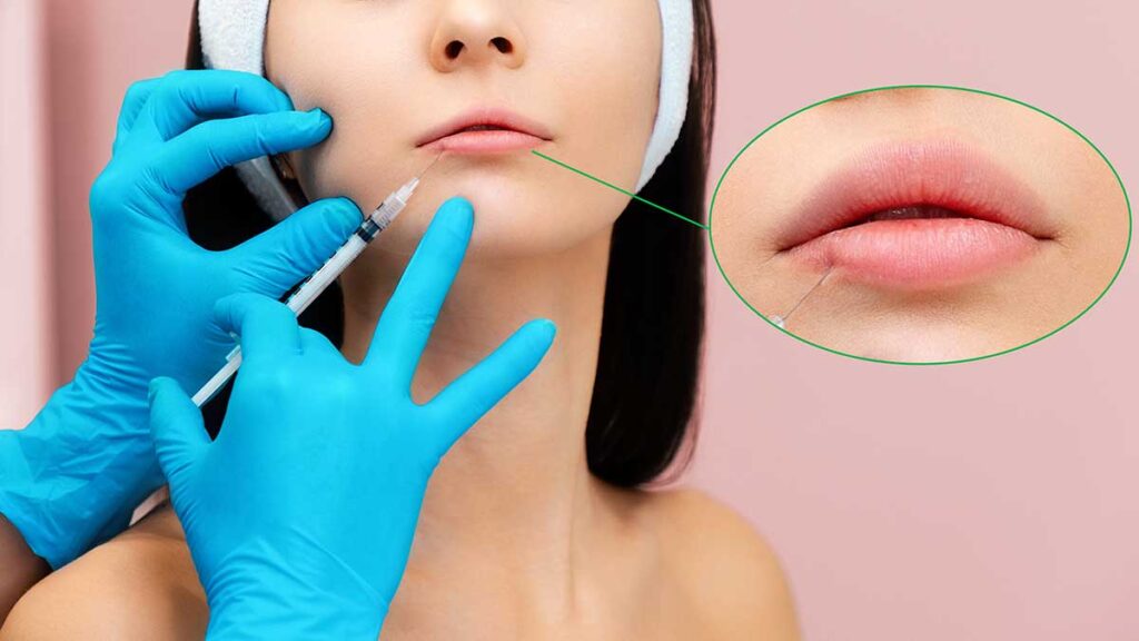 Bezbolesne powiekszenie ust w sam raz na walentynki 2022 kat