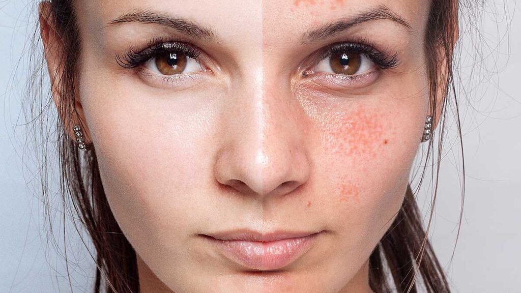 Botox for blemish free skin it is not only the wrinkles kat