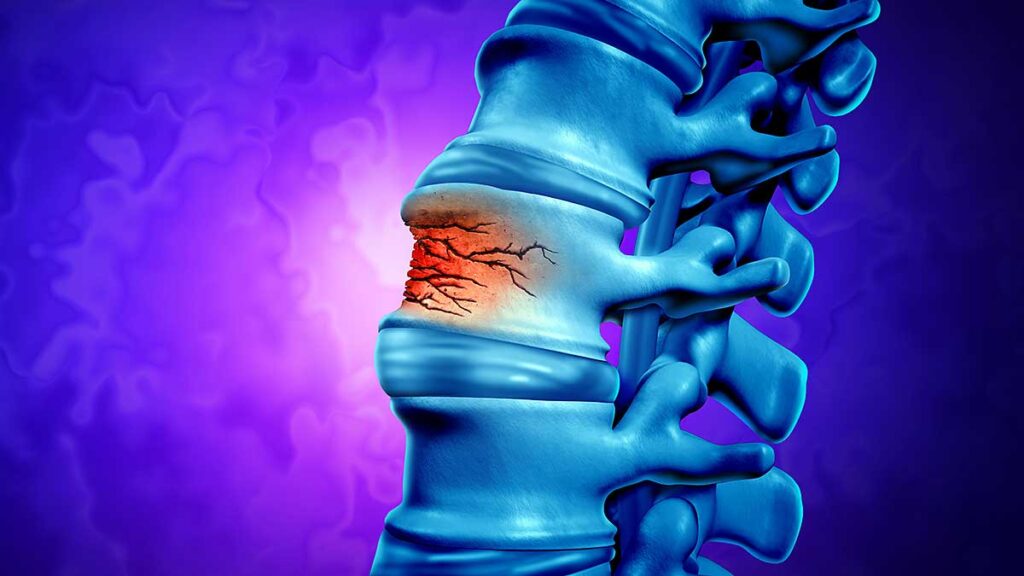 Dr nasiek about his new book miss minimally invasive spine surgery a new paradigm in the treatment of low back pain kat