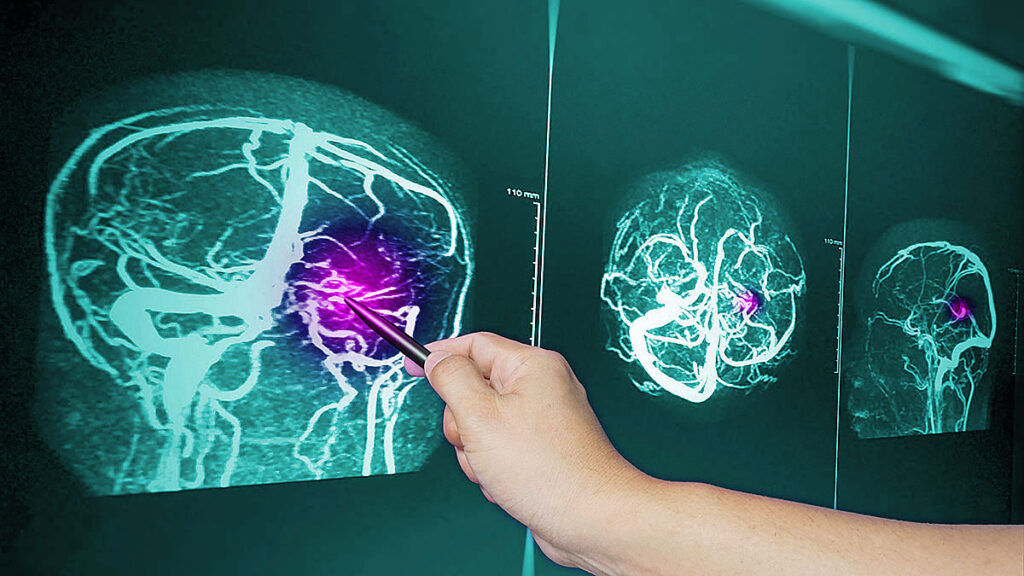Impact of tbi traumatic brain injury on the value of a legal case considering long term health consequences kat