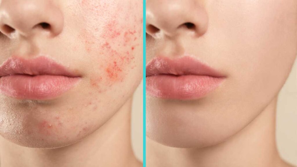 Leczenie tradziku i upiekszanie skory w new jersey polska licencjonowana kosmetyczka w garfield i hamburg cecylia esthetician kat