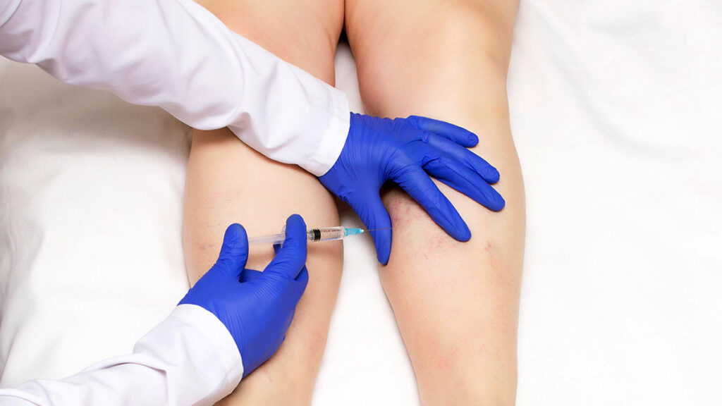 Skleroterapia leczenie zylakow pajaczkow konczyn dolnych kat