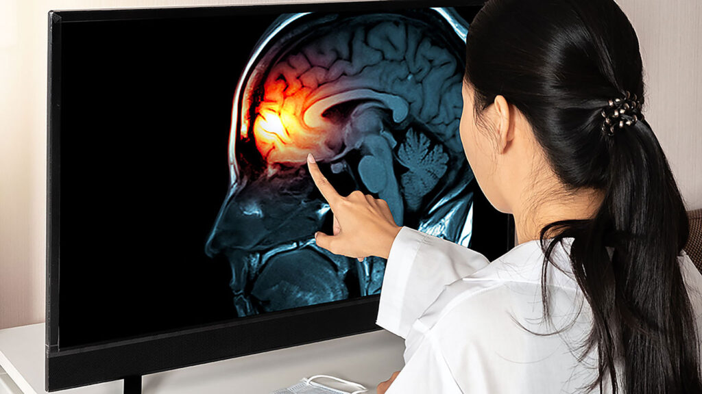 Skuteczne i nowatorskie leczenie migren bez tabletek w allied neurology interventional pain practice kat