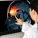 Skuteczne i nowatorskie leczenie migren bez tabletek w allied neurology interventional pain practice kat