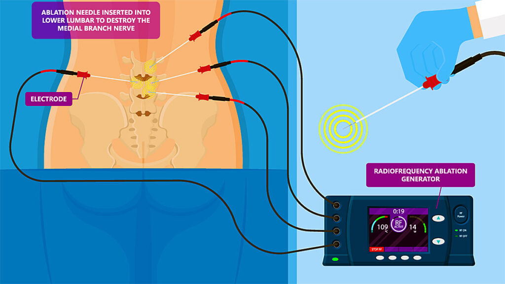 The potential of minimally invasive spine surgery dr nasiek kat