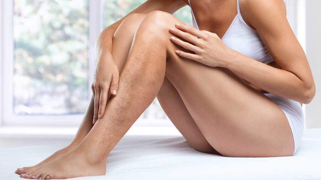 Usuwanie leczenie zylakow i pajaczkow w nj w klinice medycyny estetycznej kat