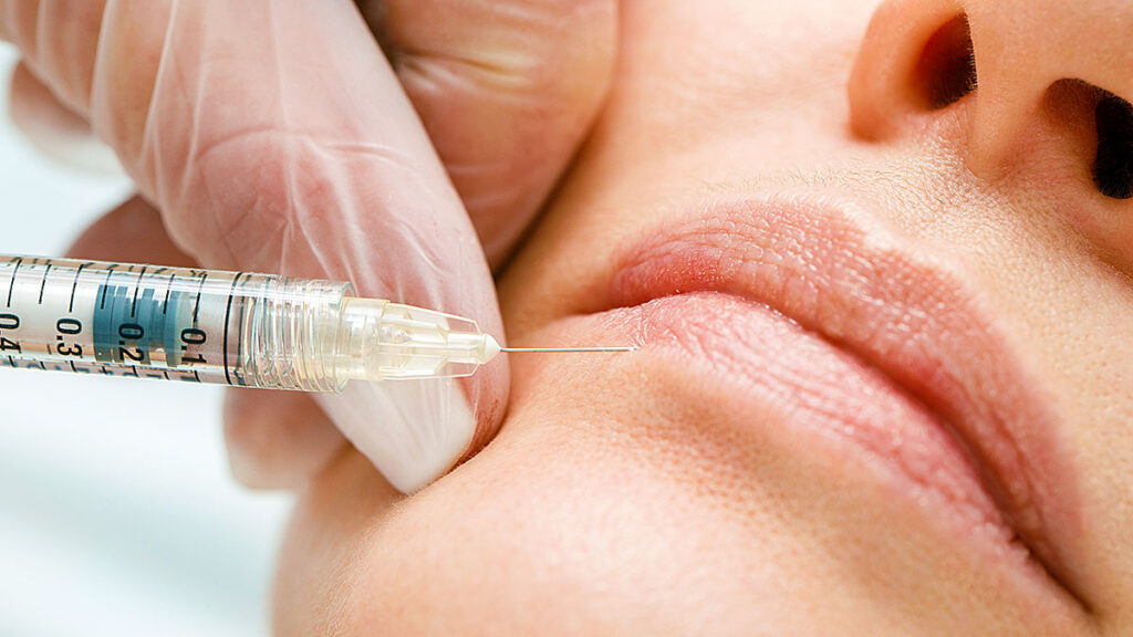 What to know about lip flips kat