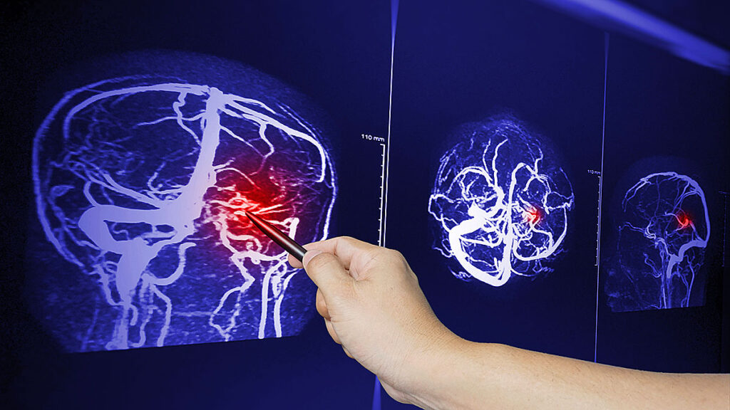 Wplyw urazu mozgu na wartosc sprawy prawnej w kontekscie dlugotrwalych konsekwencji zdrowotnych kat